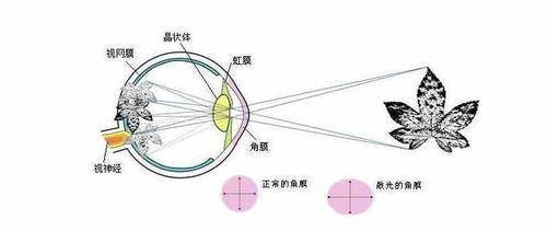 手机伤眼睛吗:经常侧卧玩手机，会导致眼睛散光吗？